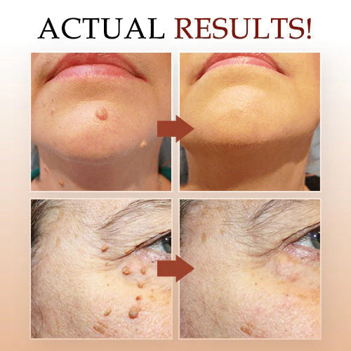 TagMo™ - Tags &amp; Moles Remover (Buy 1 Get 1 Free🔥🔥)